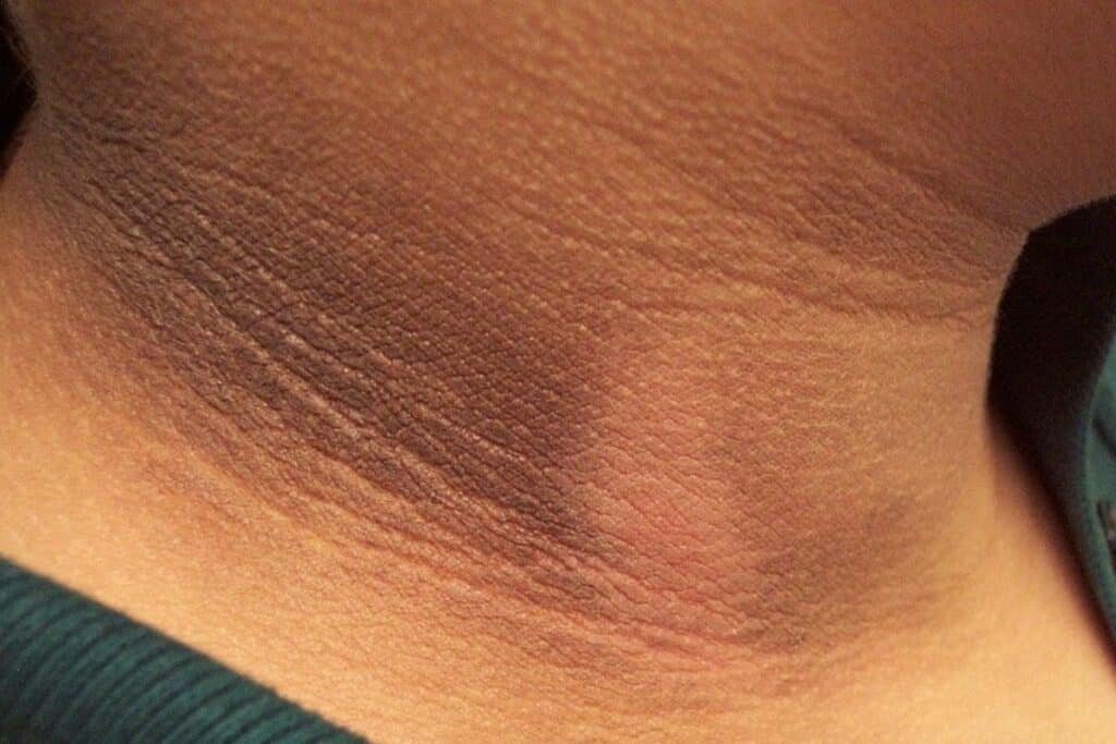 Home remedy for dark neck