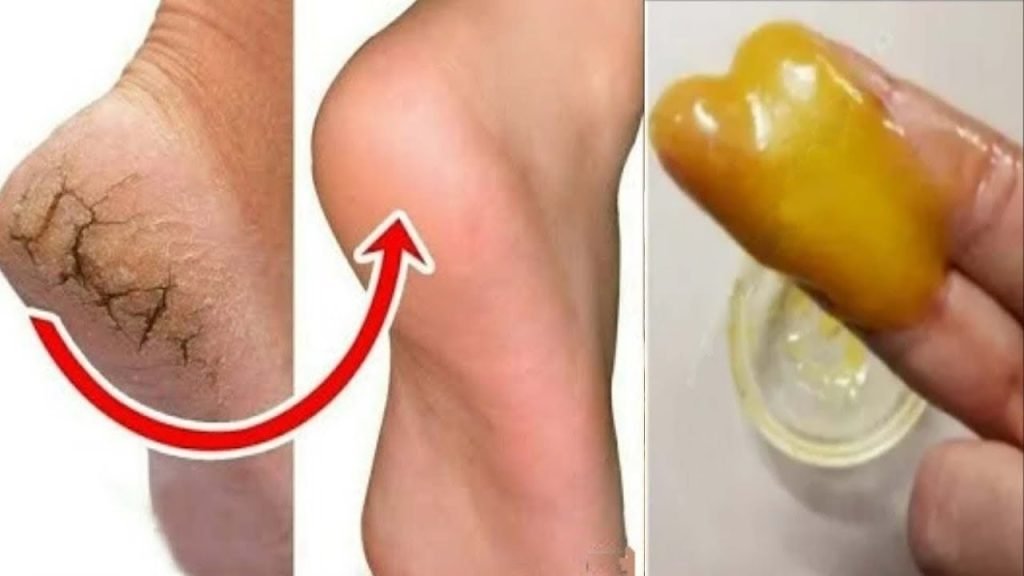 home remedies for cracked heels