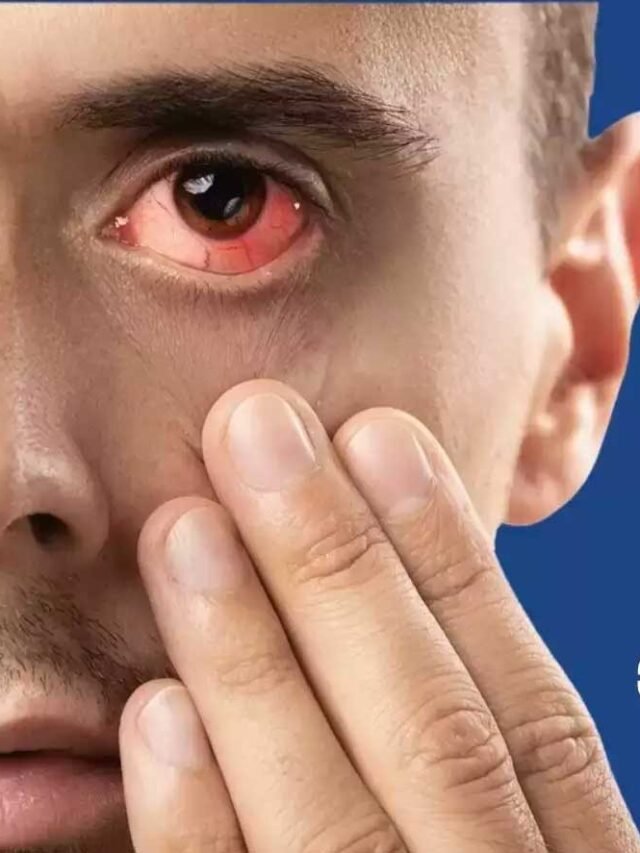 Home Remedy for eye flu : Eye Flu हो जाए तो अपनाएं ये 5 घरेलू नुस्खे