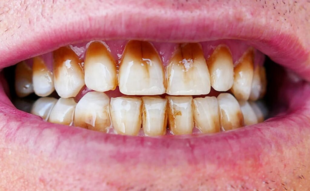 Yellow Teeth Home Remedies